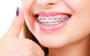 Orthodontics - Who Can Benefit from Orthodontic Treatment