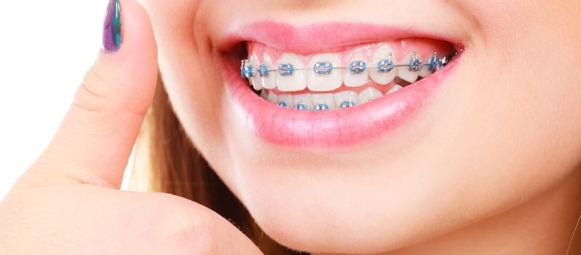 Orthodontics - Who Can Benefit from Orthodontic Treatment